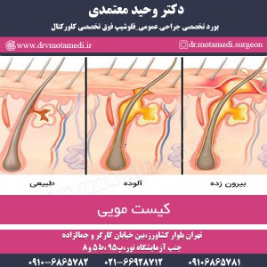 درمان کیست مویی در تهران - دکتر معتمدی