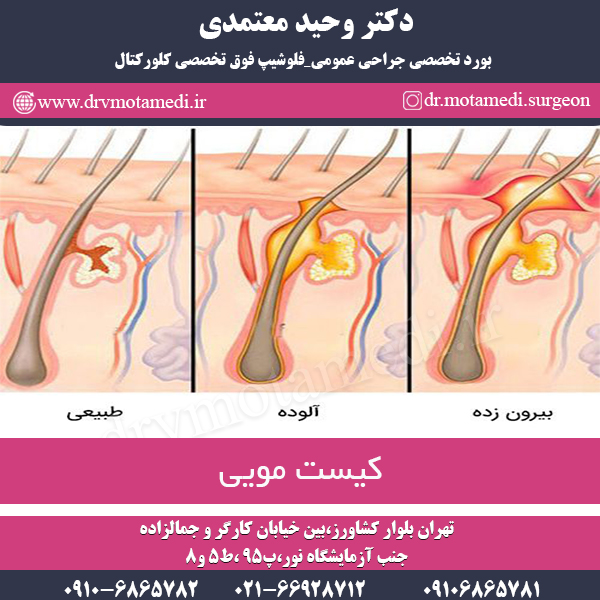 درمان کیست مویی در تهران + آشنایی با روش های درمان + دکتر معتمدی